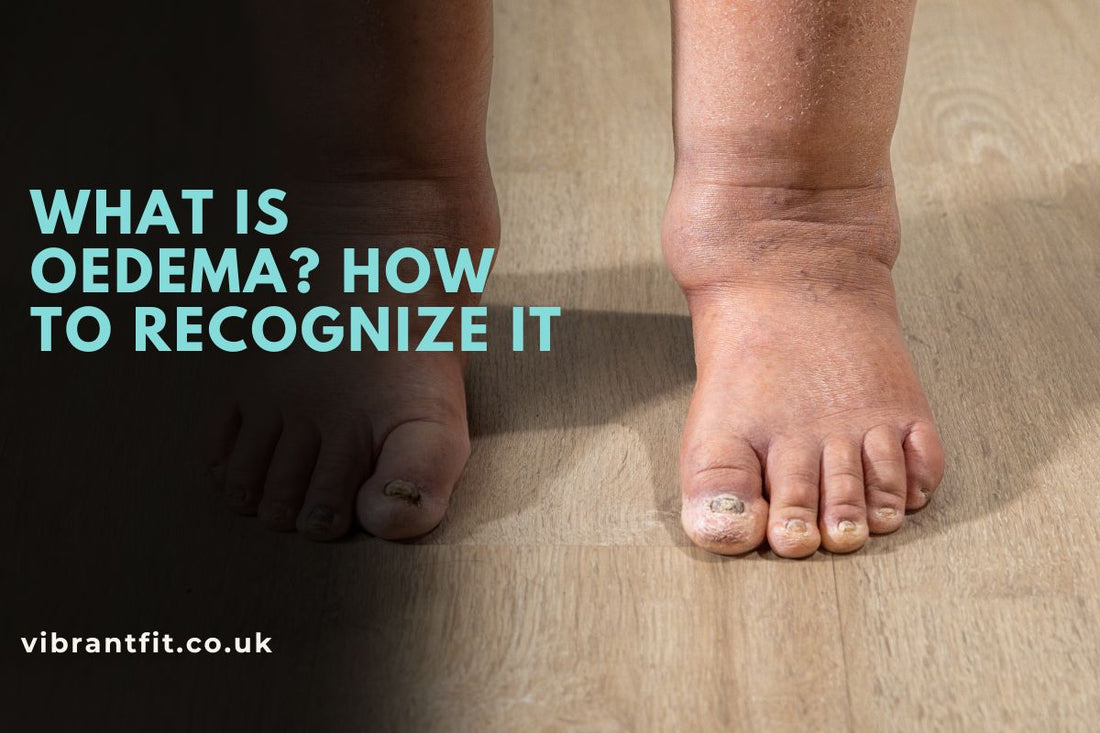 What Is Oedema? How to Recognize It